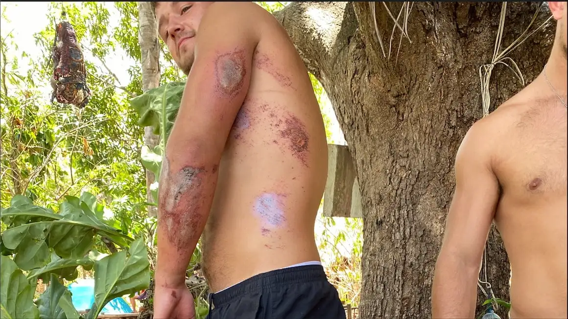 un gars avec une éruption cutanée après avoir écrasé un cyclomoteur dans la jungle