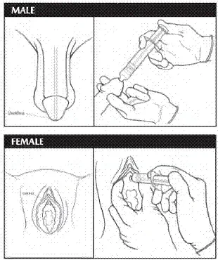 GLYDO (lidocaine HCI jelly USP 2%) should be instilled slowly and evenly into the urethra. See the DOSAGE AND ADMINISTRATION section for additional details - Illustration