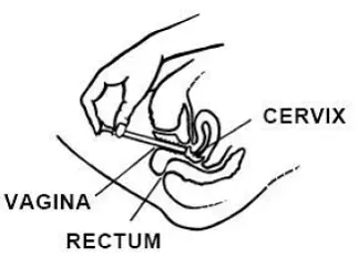 Slowly push the plunger until it stops - Illustration