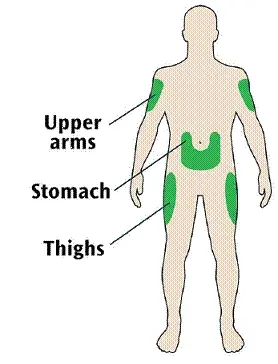 Places to inject - Illustration