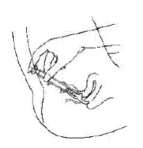 Release the cream into the vagina - Illustration