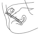 Place the flat end of the suppository into the open end of the applicator - Illustration