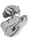 Gently squeeze the container and let 1 drop of ZIOPTAN® fall into the space between your lower eyelid and your eye. If a drop misses your eye try again - Illustration