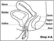 Gently insert the folded Annovera™ into your vagina - Illustration