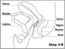 Use your index finger to gently push Annovera™ as far as you can into your vagina - Illustration