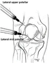 Using a lateral upper patellar or lateral mid patellar approach place needle into the joint - Illustration