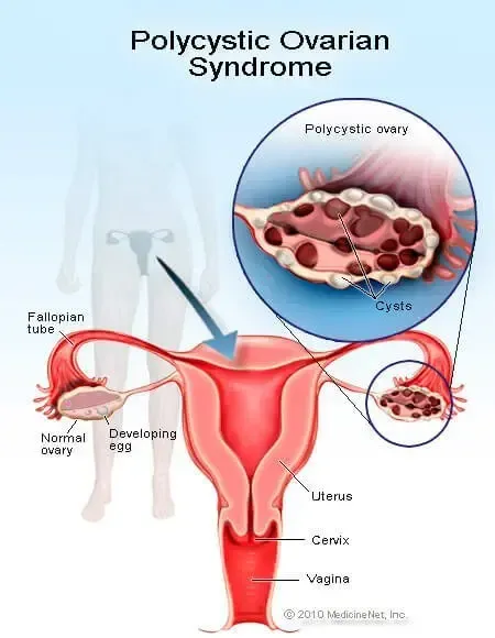 Picture of Polycystic Ovarian Syndrome (PCOS)