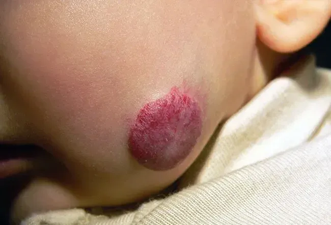 Снимка на хемангиома 1