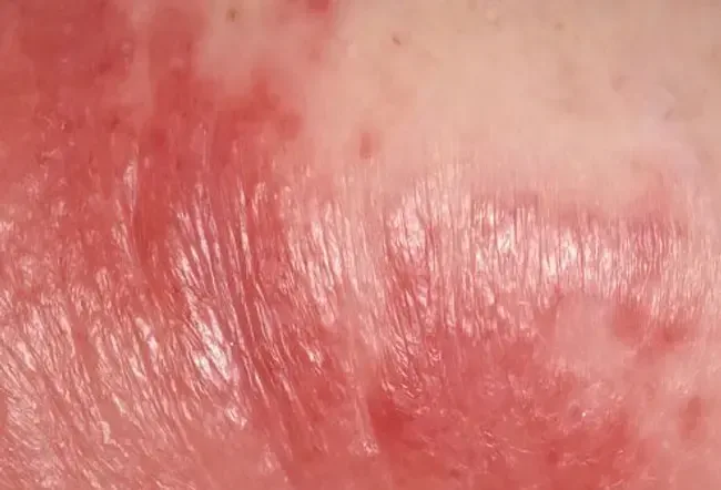 Целулит: Снимки на причини, симптоми и лечения