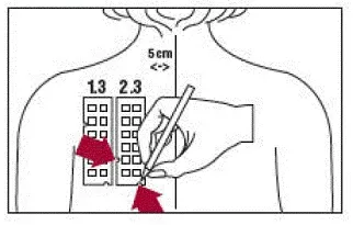 With a medical marking pen indicate on the skin the location of the two notches on the panel - Illustration
