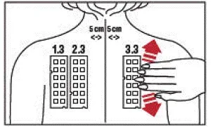 Position test panel 3.3 on the patient’s back - Illustration