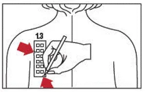 With a medical marking pen indicate on the skin the location of the two notches - Illustration
