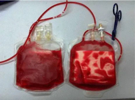 Allow all supernatant to leave bag but do not allow the RBC pellet to escape - Illustration