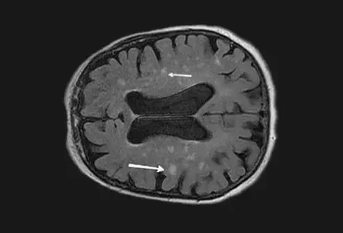 Picture of Vascular (Multi-Infarct) Dementia