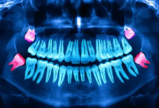 We got the name ' wisdom='' teeth'='' from='' the='' ancient='' greeks.'=