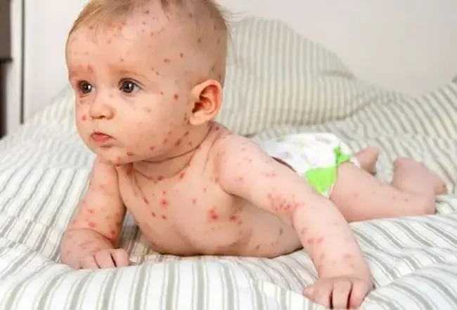 Podmínky virové kůže: Obrázky vyrážky, puchýřů a vředů u dospělých a batolat