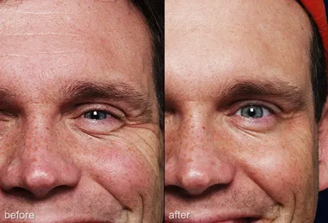 Mænds sundhed: plastisk kirurgi for mænd