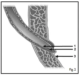 Distal ureteral tunnel - Illustration