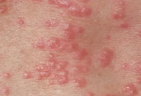 Picture of Scabies Bites