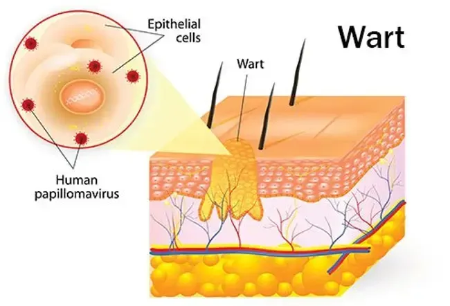 Types de verrues: symptômes, élimination et traitement