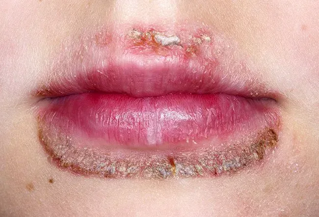 Image de la dermatite périorale