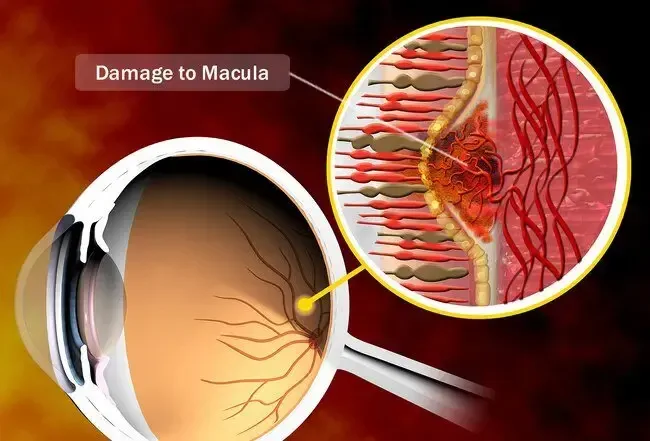 The macula is a part of the retina in the back of the eye. 