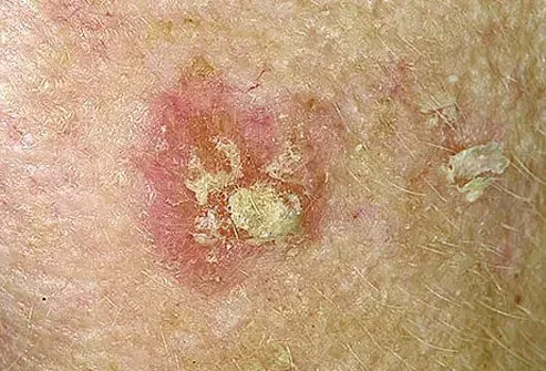 Picture of Actinic Keratosis (Solar Keratosis)