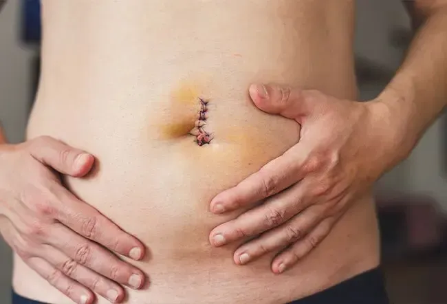 Коремна херния