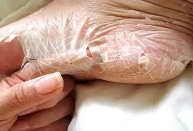 Peeling skin syndrome resembles a lifelong sunburn. 