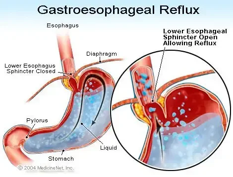 GERD illustration - Gastroesophageal reflux