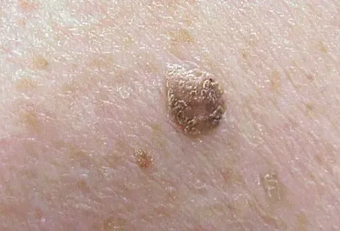 Billede af seborrheisk keratose