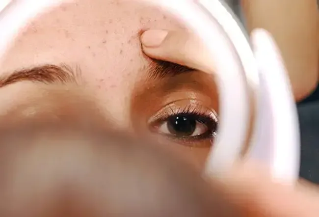 Akne: Lebensmittel, die Akne und Pickel verursachen und bekämpfen