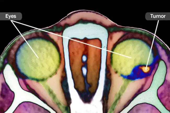 Průvodce rakovinou po očích
