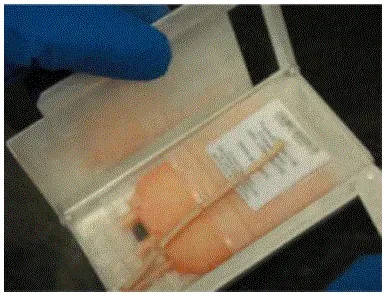 Remove the ALLOCORD unit from the cassette. Examine the cryobag for breaks or cracks - Illustration