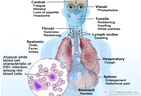 Immagine della mononucleosi infettiva