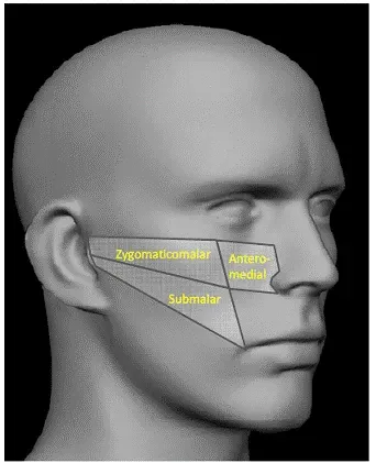 Mid-Face Regions Treated - Illustration