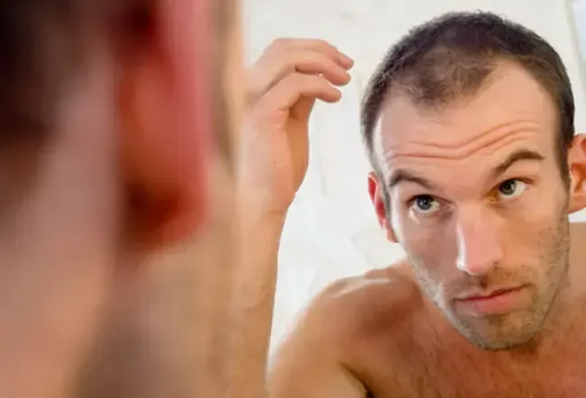 The majority of men experience hair thinning by 50. 