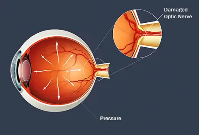 Glaucoma refers to several diseases that damage the optic nerve.