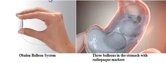 Dexcom G5 Mobile Continuous Glucose Monitoring System