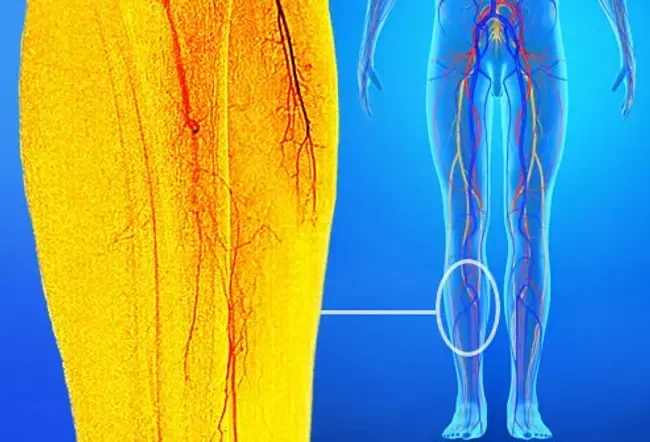 Douleur des jambes: causes et traitement des jambes, des mollets et des douleurs à la cuisse