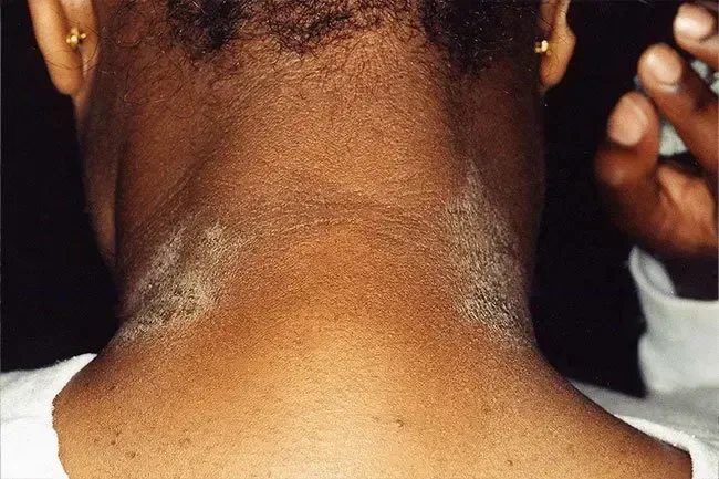 Eczema: una guida visiva alle eruzioni cutanee dell'eczema