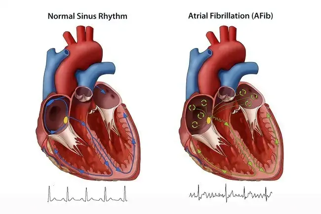 Сърдечна болест: Как да помогнем за предотвратяване на атака на AFIB