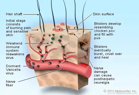 Снимка на вируса на варицела (варицела)