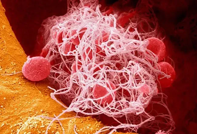 Krevní sraženiny: 4 známky, které byste mohli mít