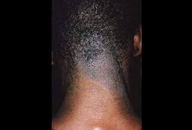 Picture of Lichen Simplex Chronicus 