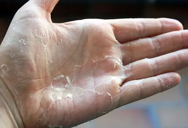 Billede af skarlagensfeber