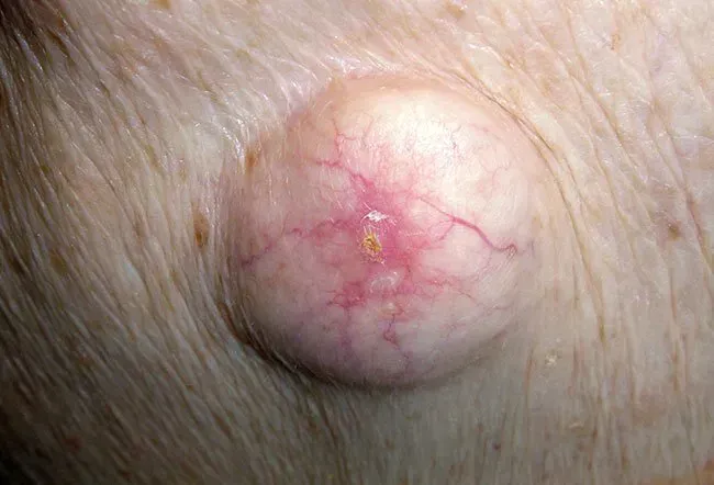 Image du kyste d'inclusion épidermique (EIC)