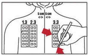 With a medical marking pen indicate on the skin the location of the two notches on the panel - Illustration