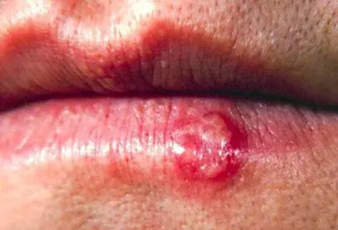 Photo des boutons de fièvre (Fever Blisters)