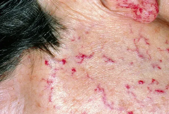 Picture of Hereditary Hemorrhagic Telangiectasia